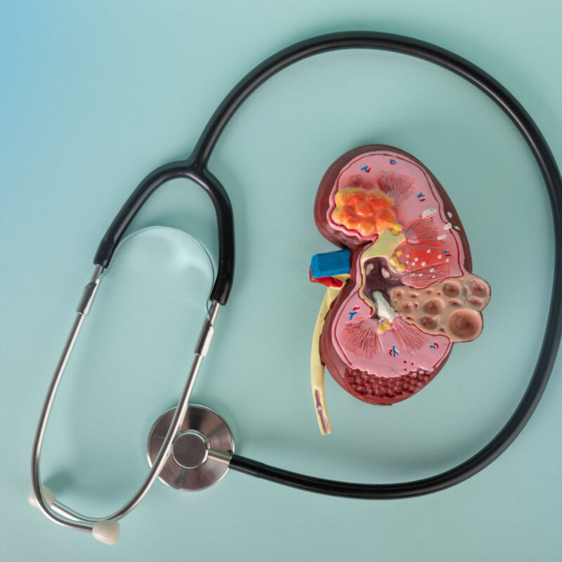 Chronic Kidney Disease: Early Symptoms, Stages, and How to Slow It Down | Dialysis for Pasig and Marikina